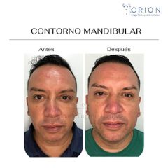 Contorno mandibular - Clínica Orion