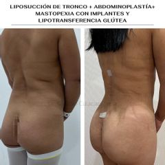 Liposucción - Clínica Orión
