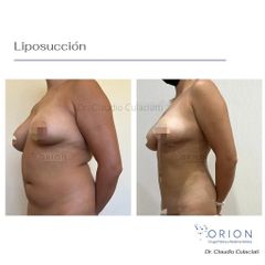 Liposucción - Clínica Orión