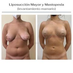 Mastopexia - Clínica Orión