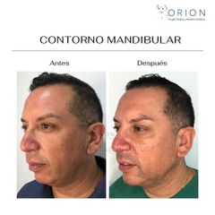 Contorno mandibular - Clínica Orion
