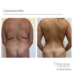 Liposucción - Clínica Orión