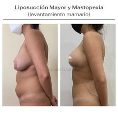 Liposucción - Clínica Orión