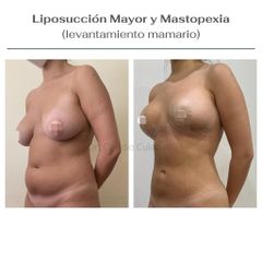 Mastopexia - Clínica Orión