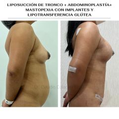 Liposucción - Clínica Orión