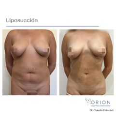 Liposucción - Clínica Orión