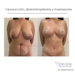Abdominoplastia - Clínica Orión