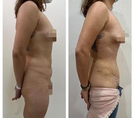 Liposucción - Clínica Orión