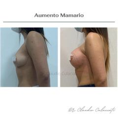 Aumento mamario - Clínica Orión