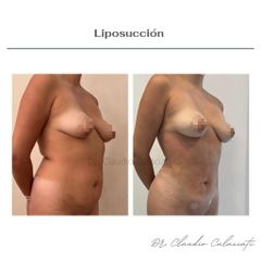 Liposucción - Clínica Orión