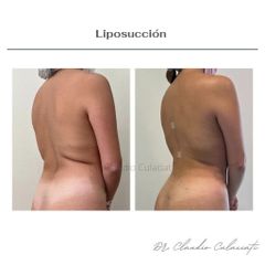 Liposucción - Clínica Orión