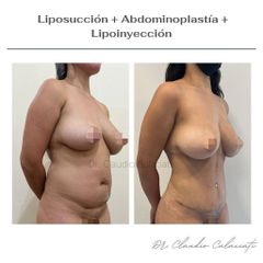 Liposucción - Clínica Orión