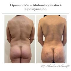 Liposucción - Clínica Orión