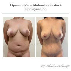 Liposucción  - Clínica Orión