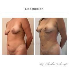 Liposucción - Clínica Orión