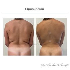 Liposucción - Clínica Orión