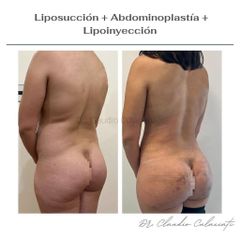 Liposucción  - Clínica Orión