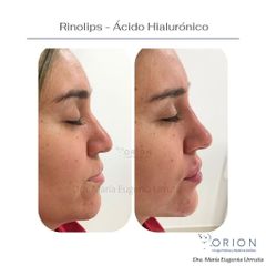 Rinolips - Ácido Hialurónico - Clinica Orion
