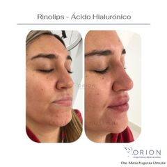 Rinolips - Ácido Hialurónico  - Clinica Orion