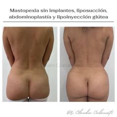 Liposucción - Clínica Orión