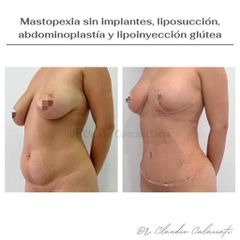 Abdominoplastia - Clínica Orión