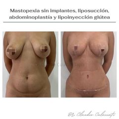 Mastopexia - Clínica Orión