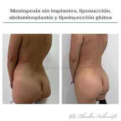 Aumento de glúteos - Clínica Orión
