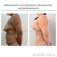 Abdominoplastia - Clínica Orión