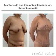 Abdominoplastia - Clínica Orión