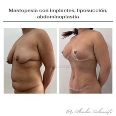 Lipoescultura - Clínica Orión