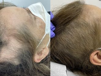 Alopecia - 831011