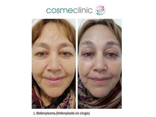 Blefaroplasma