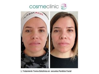 Secuelas Parálisis Facial