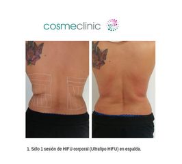 Ultralipo HIFU espalda