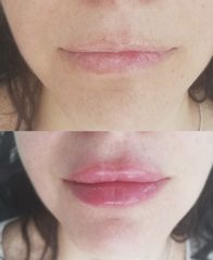Aumento de labios - Natural Studio