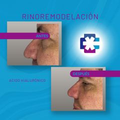 Rinomodelación  - DR Salud