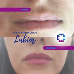 Aumento de labios - DR Salud
