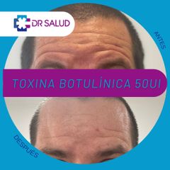 Toxina Botulínica  - DR Salud