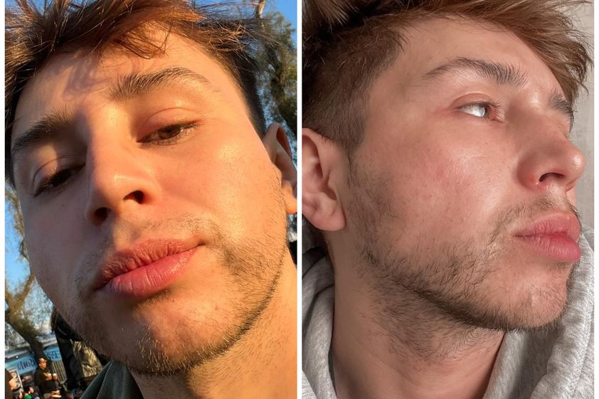 Rejuvenecimiento facial antes y después - 856147