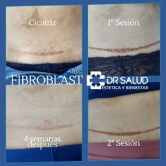 Tratamiento de cicatrices con Fibroblast - DR Salud