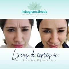 Botox - Integraesthetic