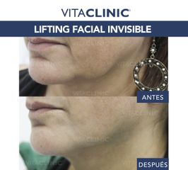 Lifting Facial Invisible - Vitaclinic