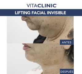 Lifting Facial Invisible - Vitaclinic