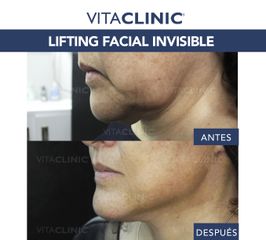 Lifting Facial Invisible - Vitaclinic