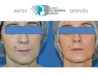 Antes y Despues Labios Finos