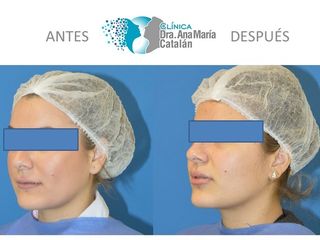 Antes y Después labios