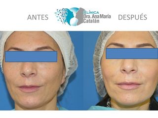 Antes y Después Labios y Ojeras