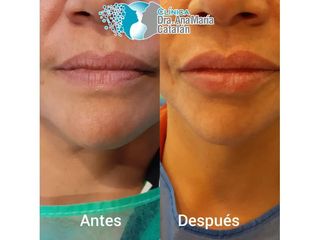 Aumento de labios