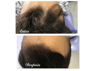 Alopecia - 636743