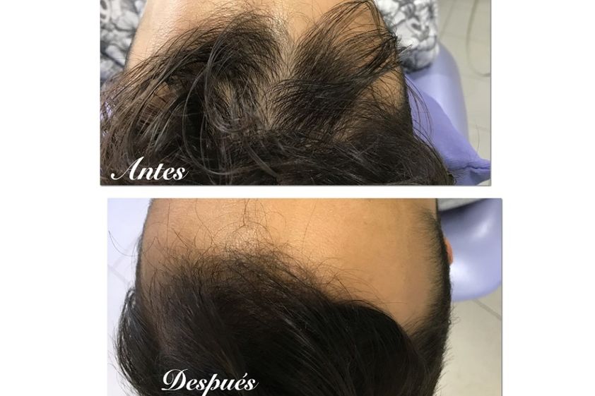 Alopecia antes y después - 636743